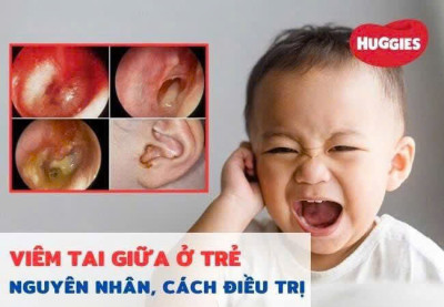 PHÒNG BỆNH VIÊM TAI GIỮA CẤP CHO TRẺ
