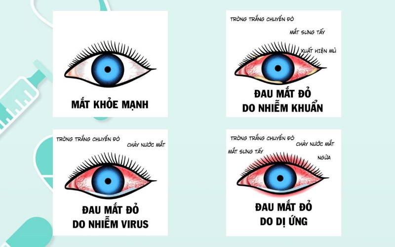Chế độ dinh dưỡng cho trẻ bệnh đau mắt đỏ